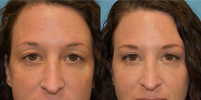 Eyelid Surgery before and after photo