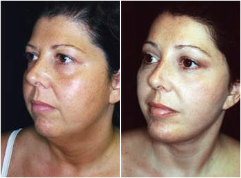 Facelift before and after photo