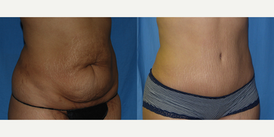Liposuction before and after photo