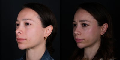 Revision Rhinoplasty before and after photo