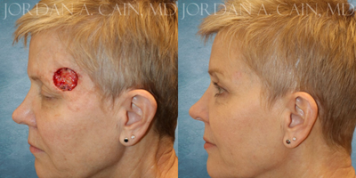 Facial Reconstructive Surgery before and after photo