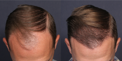 FUE Hair Transplant before and after photo