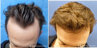 Hair Transplant before and after photo