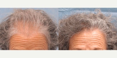 Hair Transplant before and after photo