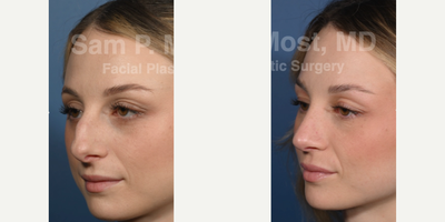 Rhinoplasty before and after photo