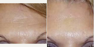 Botox before and after photo