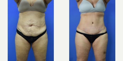 Brazilian Butt Lift before and after photo