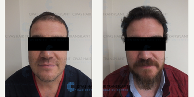 Hair Loss Treatment before and after photo