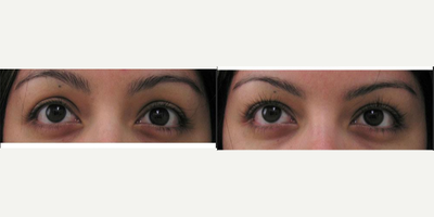 Latisse before and after photo