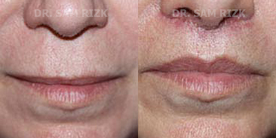 Lip Fillers before and after photo
