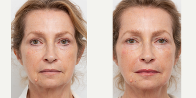 Liquid Facelift before and after photo