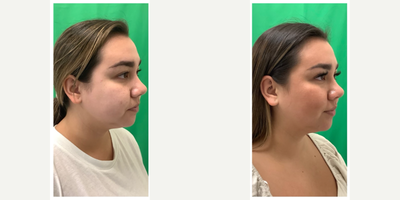 Morpheus8 before and after photo