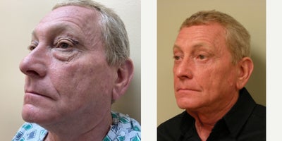 Eyelid Surgery before and after photo