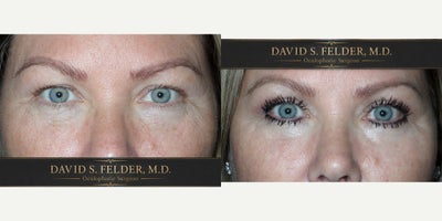 Eyelid Surgery before and after photo