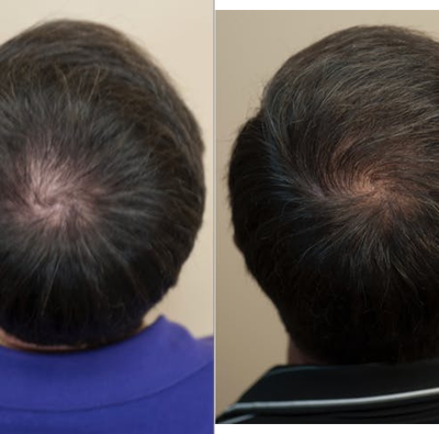 Hair Loss Treatment before and after photo