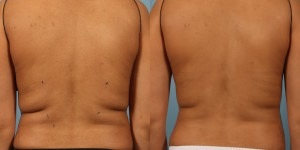 CoolSculpting before and after photo