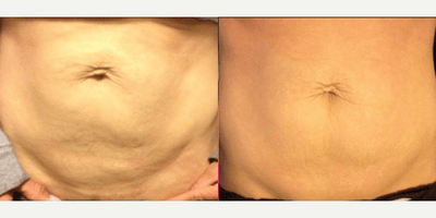 CoolSculpting before and after photo