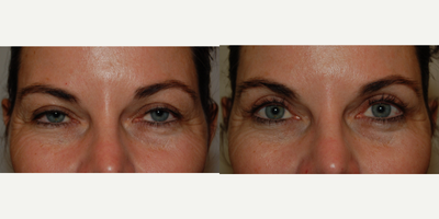 Eyelid Surgery before and after photo