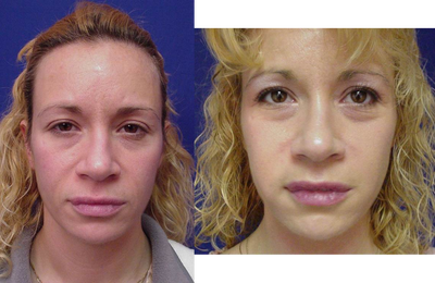 Facial before and after photo