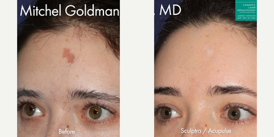 Laser Resurfacing before and after photo
