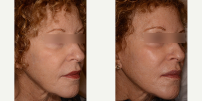 Voluma before and after photo