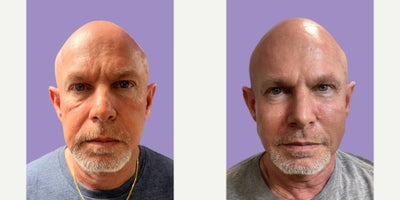 Cheek Fillers before and after photo