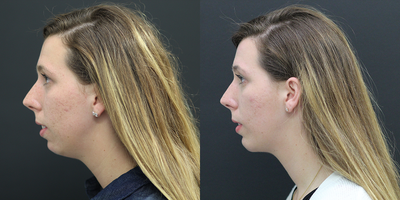 Chin Implant before and after photo