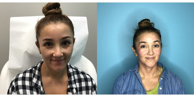 Dermal Fillers before and after photo