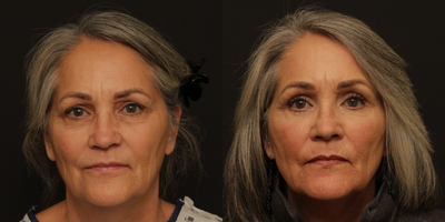 Eyelid Surgery before and after photo