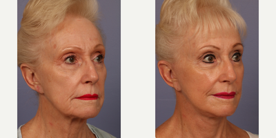 Facelift before and after photo