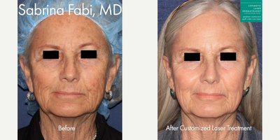 Laser Resurfacing before and after photo