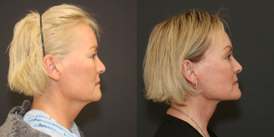 Mini Facelift before and after photo