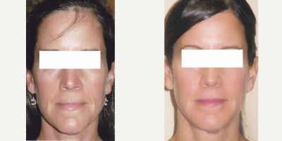 Sculptra before and after photo