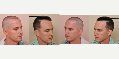 ARTAS Robotic Hair Transplant before and after photo