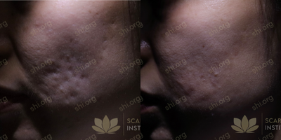 Dermal Fillers before and after photo