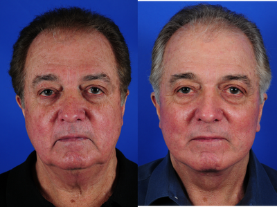 Neck Lift before and after photo