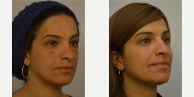 Cosmelan before and after photo