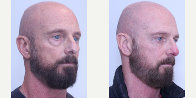Eyelid Surgery before and after photo