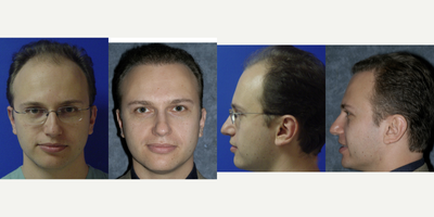 Hair Transplant before and after photo