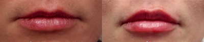 Lip Fillers before and after photo