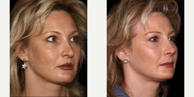 Revision Rhinoplasty before and after photo