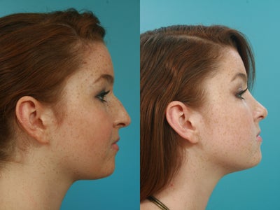 Rhinoplasty before and after photo