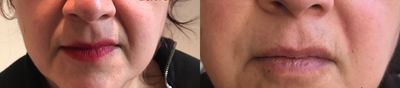 Dermal Fillers before and after photo
