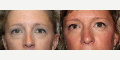 Eyelid Surgery before and after photo