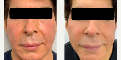Laser Resurfacing before and after photo