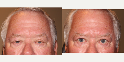 Ptosis Surgery before and after photo