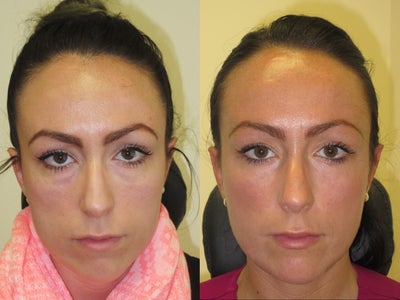 Cheek Fillers before and after photo