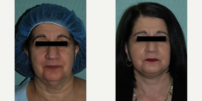 Facelift before and after photo