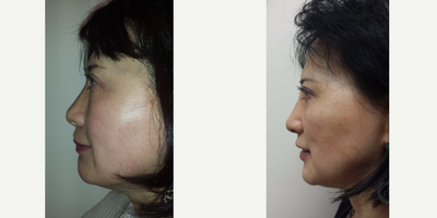 Nonsurgical Nose Job before and after photo