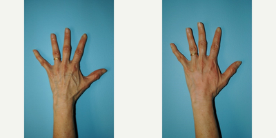 Radiesse before and after photo